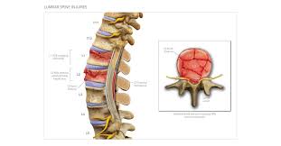 Shop for l1 snowboard jackets and pants at tactics. L1 L2 Lumbar Spine Injuries High Impact Visual Litigation Strategies