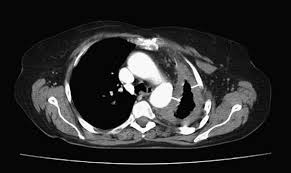 Assessment Of Tumor Response In Malignant Pleural Mesothelioma Cancer Treatment Reviews