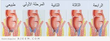 استرخى معدات ميداني سبب بواسير النساء consultoriaorigenydestino com