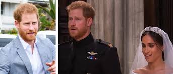 Prince Harry's Hair Transplant – Did It ...