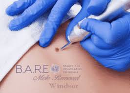 Best Laser Hair Removal Clinic in Windsor, Ontario