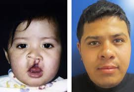 Looking for plastic surgery services in apple valley & victorville? Nonprofit Group Provides Free Reconstructive Surgery To Disadvantaged Children Press Enterprise