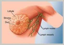 When malignant cancer cells form and grow within a person's breast tissue, breast cancer occurs. What Is Cost Of Breast Cancer Surgery In India Breast Treatment India