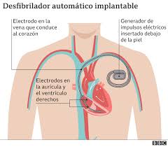 Es un desfibrilador portátil, que analiza el ritmo y emite una descarga automática bidireccional (de electrodo a electrodo) de 200j de potencia. P59o1nrblscsym