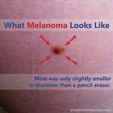 Know what to look for to help catch it early. Melanoma International Foundation Melanomaintl Profile Pinterest