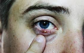 A sty typically goes away on its own. Eye Stye Treatment What Causes Eye Styes Men S Health