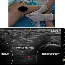 Image result for Pudendal Block