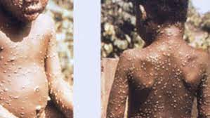 Monkeypox virus present in human vesicular fluid. Jw2fkweqbze Om