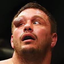 We've seen some brutal eye injuries down the years in ufc with molly mccann, niko price and rose namajumas all sticking out. Matt Mitrione S Eye Injury After Defeat At Ufc Fight Night 81 Last Night Was Brutal B R Football Scoopnest