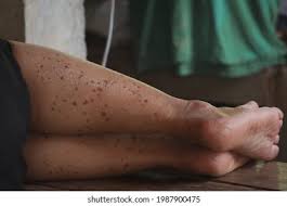 Image result for liver spots on legs