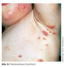 Image result for scabies effects on the human body