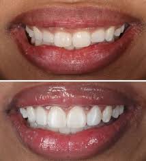 Steven novick specializes in gum contouring procedures that can help you achieve the balanced and beautiful smile, you deserve. Gum Contouring How Does This New Gummy Smile Treatment Work