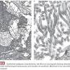 Mesothelioma pathology outlines, let's fight cancer. Https Encrypted Tbn0 Gstatic Com Images Q Tbn And9gcqase49njirx7f8cefbk8jpq5ytqiiswqt148a65zcul2isyxdy Usqp Cau
