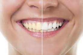 Found from the krazy coupon lady. How To Get Rid Of Yellow Teeth Overnight Bondi Dental