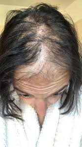 Hair loss after pregnancy is the sudden shedding (sometimes in clumps) that many new mothers experience between three and six months after you can't do anything to stop your hair falling out postpartum. I Lost All My Hair After Having A Baby And It Never Grew Back People Think I Have Cancer