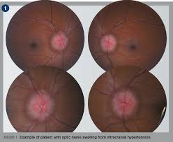 Image result for Optic Neuritis