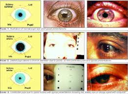 Eye Screening And Intractable Pain Management