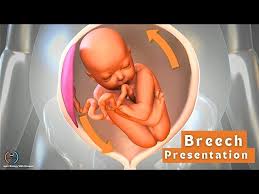 Image result for Breech Delivery