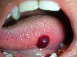 Could there be any medical condition that causes blood blisters to occur in the mouth, on the tongue, on the cheek, and the throat? Blisters Quotes Quotesgram
