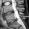 When a disc in your back is herniated the jam in the centre oozes out of its correct position. 1