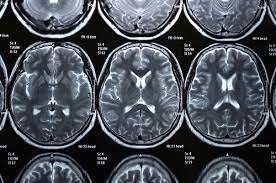 Stroke Risk In Sle May Be Linked To Cerebral Small Vessel Disease