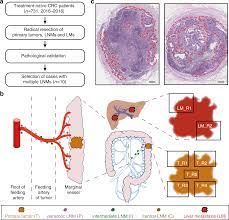 This spread of cancer to a new part of the body is called metastasis. Mapping The Spreading Routes Of Lymphatic Metastases In Human Colorectal Cancer Nature Communications