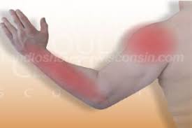 Tendons are delicate groups of connective tissue that append muscles to bones and enable joints to flex and broaden. Tendonitis