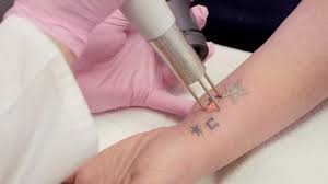 Typically, completely removing a tattoo will require many treatment sessions. Pains Process Of Tattoo Removal
