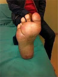 Conservative Surgery of Diabetic Forefoot Osteomyelitis