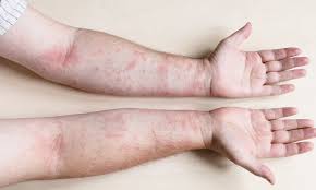 Image result for dermatitis contacta allergica