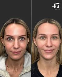 Cameron Bowling, BSN, RN (@injectorcam) • Instagram photos and videos