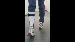 Cela signifie quelle se transmet de façon très irrégulière et qu'elle peut sauter des générations. Charcot Marie Tooth Releveur De Pied Pneumaflex Youtube