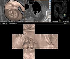 Image result for Colon Cancer Screening with Colonoscopy