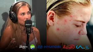 Por qué se produce el acné en adultos? La dermatóloga Elizabeth Valle tiene  la respuesta