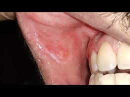 You could have developed the white spots on gum as a result of inside mouth peeling. How To Clear White Patch In The Mouth Youtube