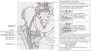 Image result for Obturator Nerve Compression