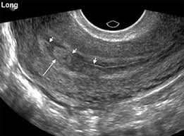 Image result for First Trimester Ultrasound