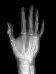 Stress fractures are tiny cracks in a bone. Metacarpal Neck Fractures Except Thumb Injuries Poisoning Msd Manual Professional Edition