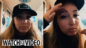 I got a hair transplant