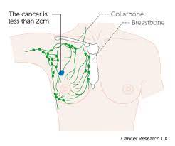 Breast cancer is the second most common cancer found in women — after skin cancer — but that doesn't mean men aren't at risk as well. Stage 1 Breast Cancer Cancer Research Uk