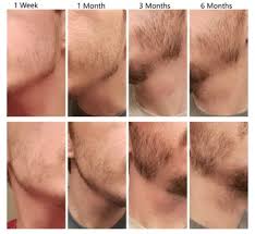 Healthy facial hair growth is somehow associated with a healthy diet. Is There A Proven Way To Grow Facial Hair The Science