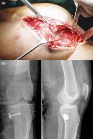 As of june 25, 2013, mcl has. A Complete Avulsion Of The Medial Collateral Ligament Mcl From Its Download Scientific Diagram