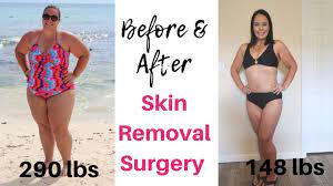 Following a gastric bypass, sometimes the skin in the abdominal area, flanks, buttocks, breasts, and upper arms may become loose. Before After Skin Removal Surgery After Vsg Gastric Sleeve Surgery 150 Lb Weight Loss Youtube