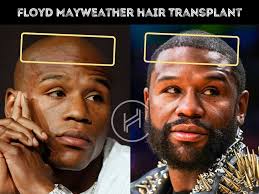 Floyd Mayweather Hair Transplant
