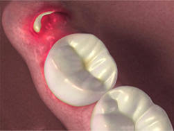 Within a day or two, the socket starts filling with repair tissue. Will Antibiotics Stop Tooth Pain Reddit