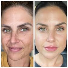 What is the best overnight moisturizer that is ance safe and addresses  wrinkles?