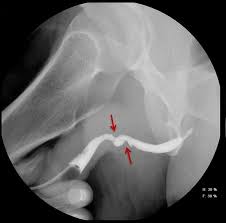 Image result for Retrograde Urethrogram