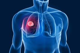 Lung cancer usually starts in the cells that line the inside of the lungs. All You Need To Know About Lung Cancer Thehealthsite Com