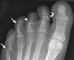 Psoriatic Arthritis Anteroposterior Foot Radiograph Shows Inflammatory And Destructive Changes Of Fifth Metatarsoph Arthritis Curved Arrow Psoriatic Arthritis