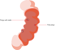Image result for Colonic Polyp